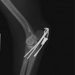 Elbow VLR