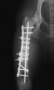 Fracture bad VLR