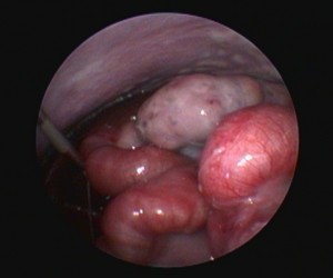 Laparoscopic view